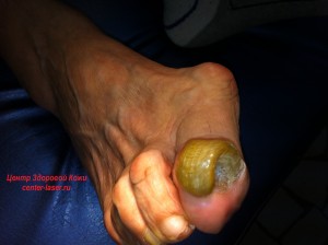 Лечение грибка ногтей на ногах в уфе thumbnail